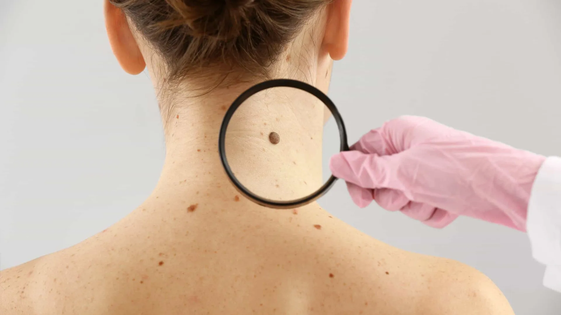 regra-abcde-ajuda-a-identificar-sinais-de-cancer-de-pele,-alerta-medico