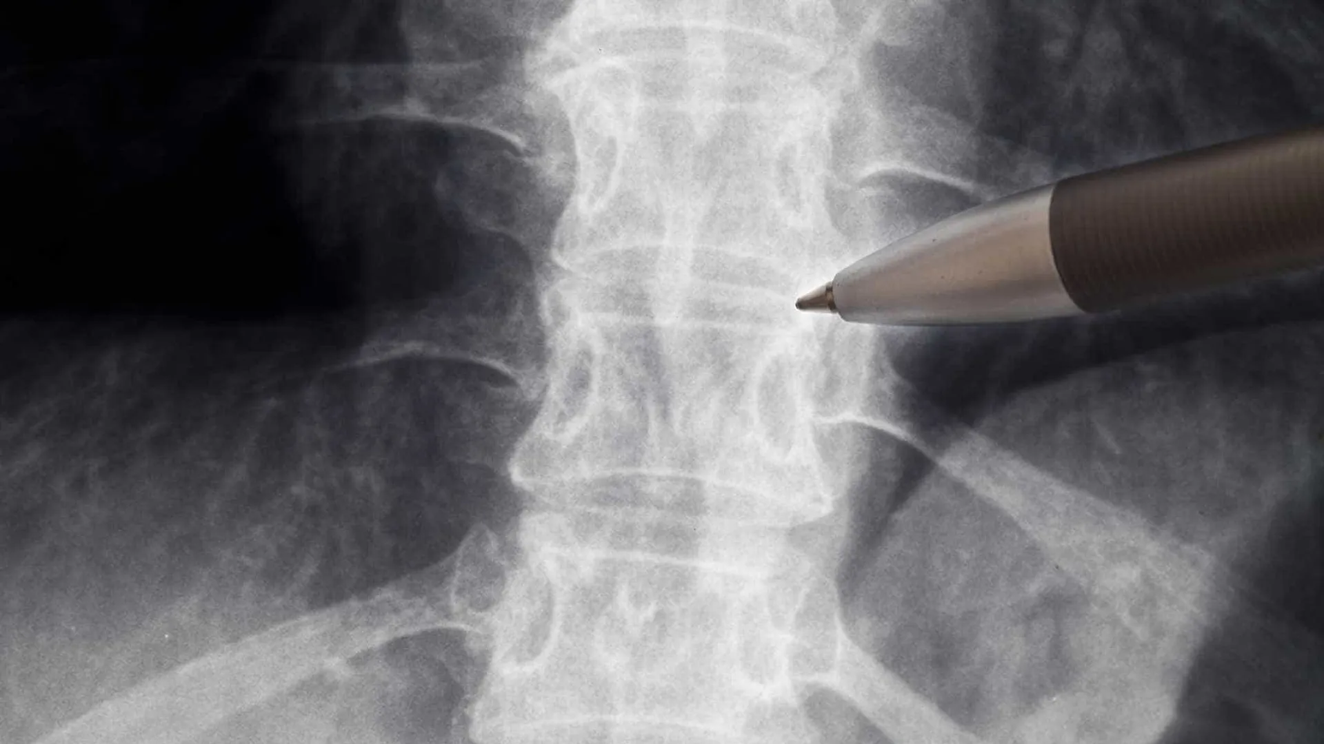 anvisa-libera-estudo-com-medicamento-para-lesoes-na-medula-espinhal