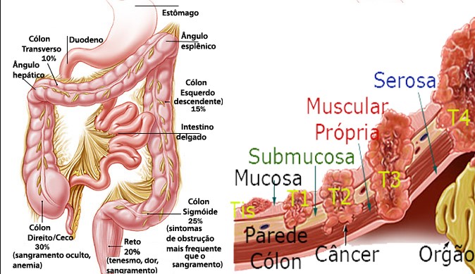 cancer-colorretal-avanca-entre-jovens-e-ja-atinge-1-em-cada-5-pacientes-antes-dos-55-anos