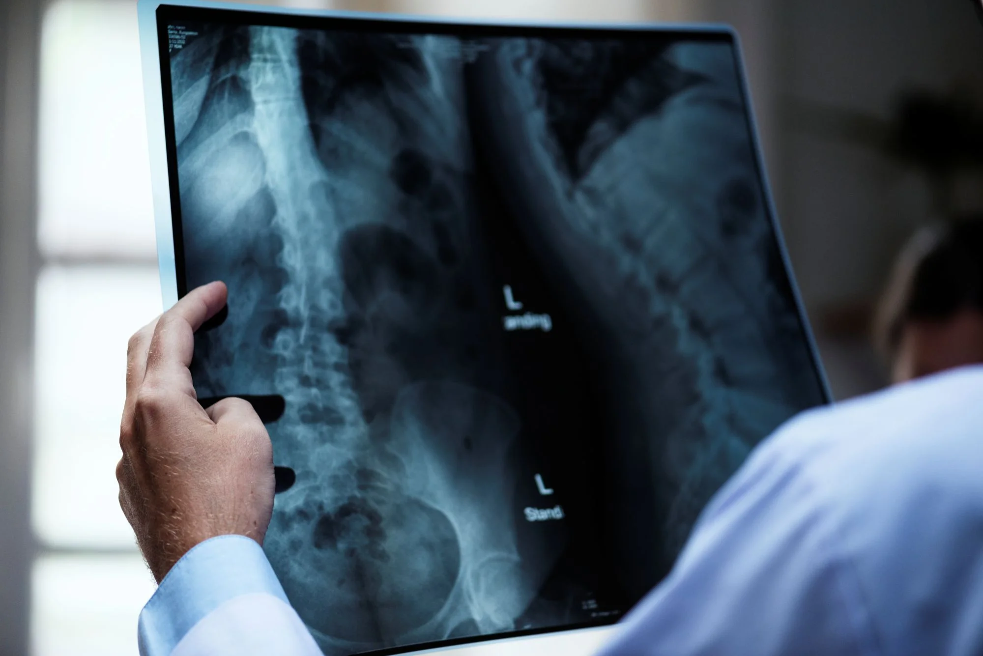 osteoporose-atinge-homens-e-mulheres-de-maneira-diferente;-veja-cuidados