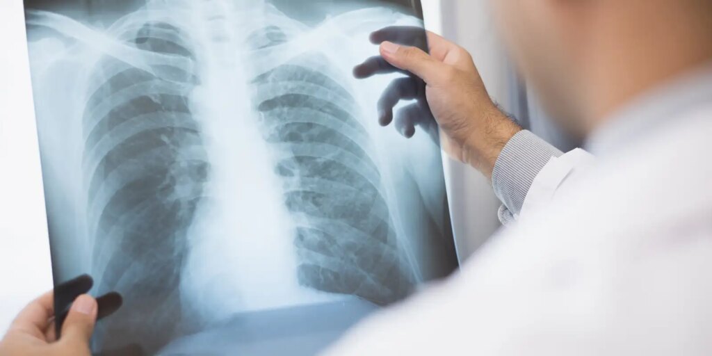 anvisa-aprova-novo-medicamento-para-cancer-de-pulmao-avancado